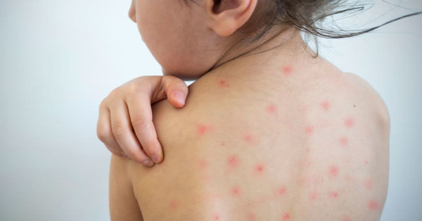 WATCH: Medical Experts Warn Of Measles And TB Catastrophe In Sanctuary Cities